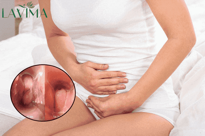 Nấm âm đạo gây ngứa ngáy, nóng rát rất khó chịu