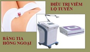 Điều trị viêm lộ tuyến bằng tia hồng ngoại