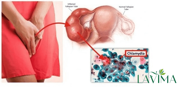 Đau bụng dưới và ra khí hư do nhiễm khuẩn  Chlamydia Trachomatis