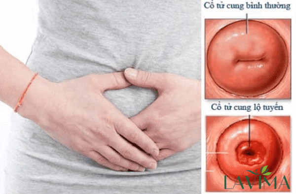 Đau bụng dưới và ra khí hư do viêm lộ tuyến cổ tử cung