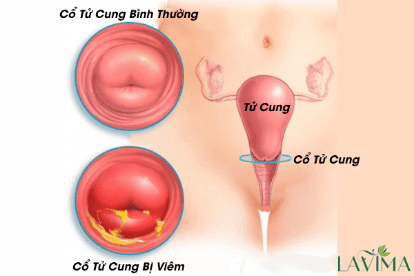 3. Cách điều trị và phòng ngừa