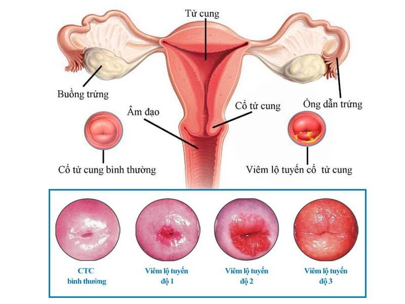 4. Phòng ngừa viêm cổ tử cung