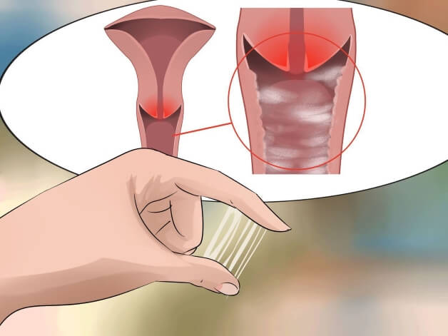 Viêm lộ tuyến cổ tử cung: Nguyên nhân, chẩn đoán và dấu hiệu