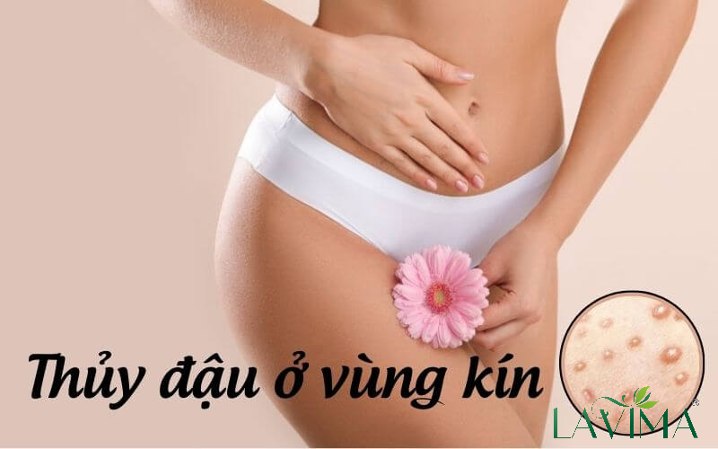 3. Triệu chứng bệnh thủy đậu ở vùng kín