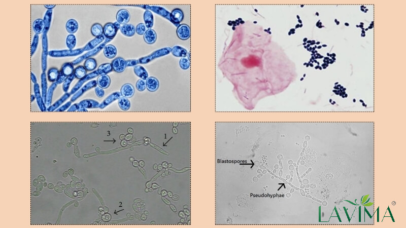 Hình ảnh nấm Candida và cách thử nấm đơn giản bạn cần biết