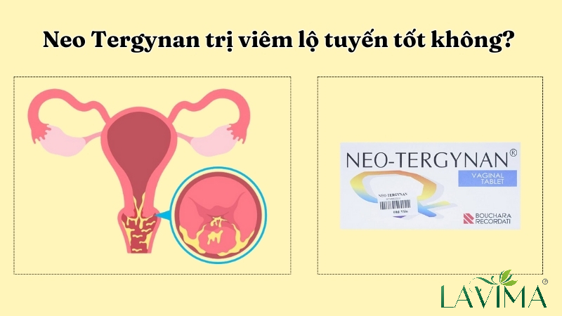 Neo Tergynan là thuốc gì? Hướng dẫn dùng Neo Tergynan trị viêm lộ tuyến đúng cách
