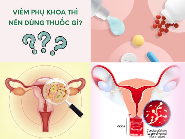 Bị Viêm Phụ Khoa Uống Thuốc Gì Nhanh Khỏi? 7 Bị Viêm Phụ Khoa Uống Thuốc Gì Nhanh Khỏi?
